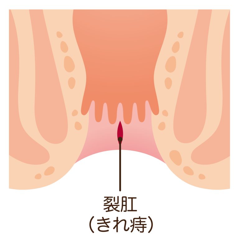 切れ痔