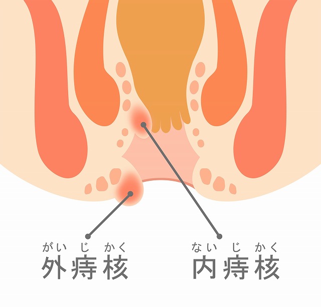 痔核(いぼ痔)